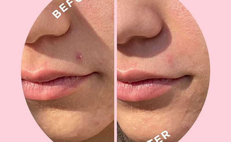 microneedle Acne patch microneedle Acne patch